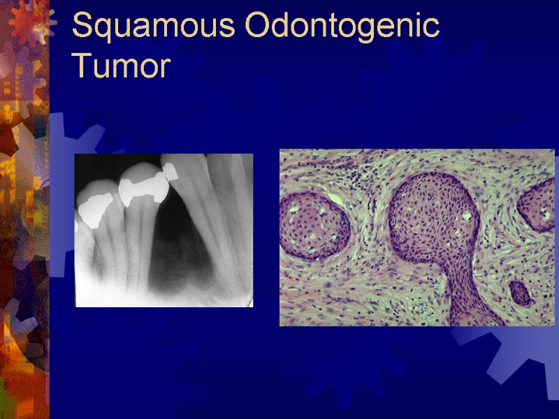 Squamous Odontogenic Tumor